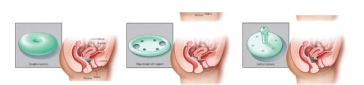 Urinary Tract Infection