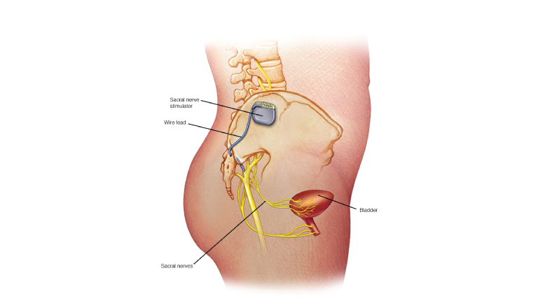 Urinary Tract Infection