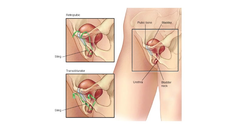 Urinary Tract Infection